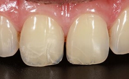 ترک ها و شکستگی های دندانی