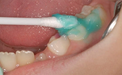 در مورد وارنیش فلوراید بیشتر بدانیم